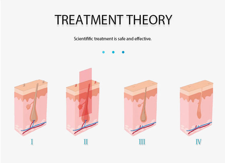 IPL Elight SHR hair removal
