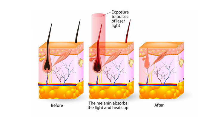 SHR IPL RF Elight hair removal machine