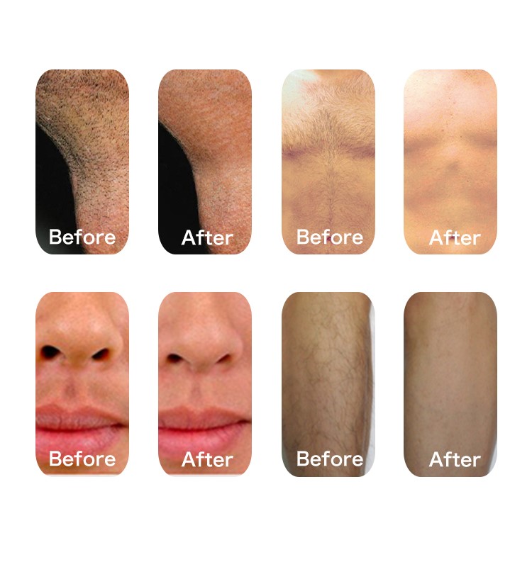 SHR IPL RF Elight hair removal machine