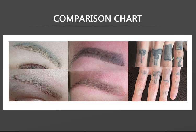 Q Switch Nd Yag Tattoo Removal Machine