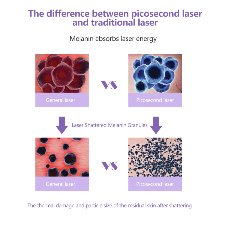 Pico Laser Tattoo Removal