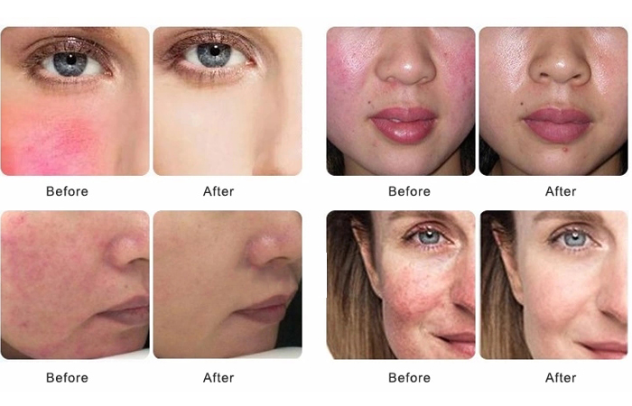Blood Vessels Removal