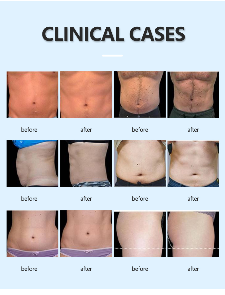 Fat freezing Muscle building