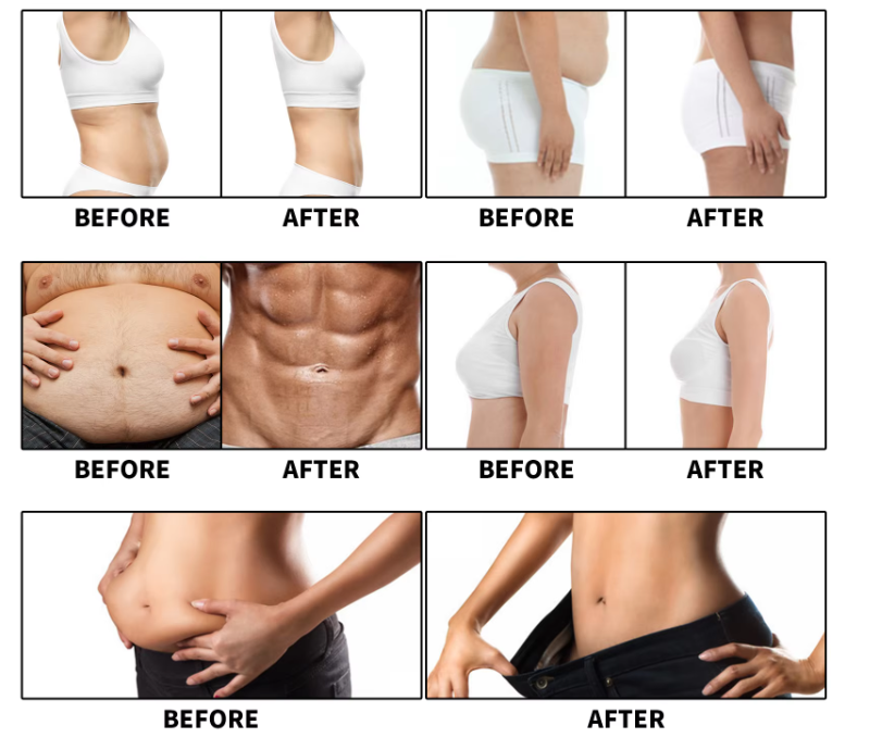 ems sculpting machine