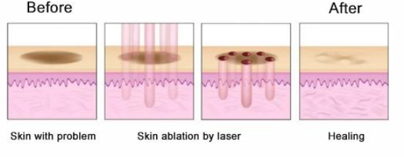 Android Fractional CO2 Laser machine