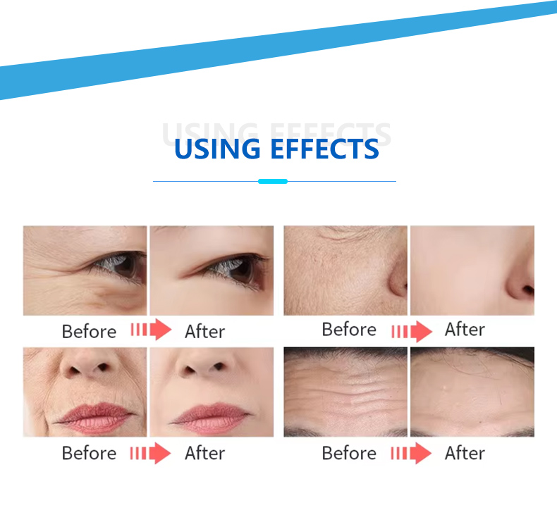 EMRF Face Lifting Machine