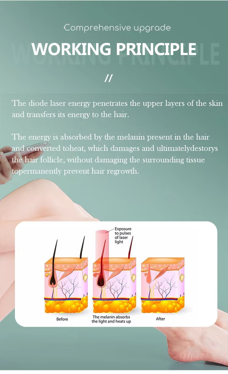 Diode Hair Removal Machine Supplier