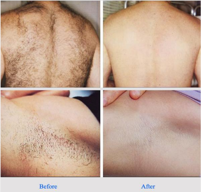 How to Prepare for Your Laser Hair Removal Treatment