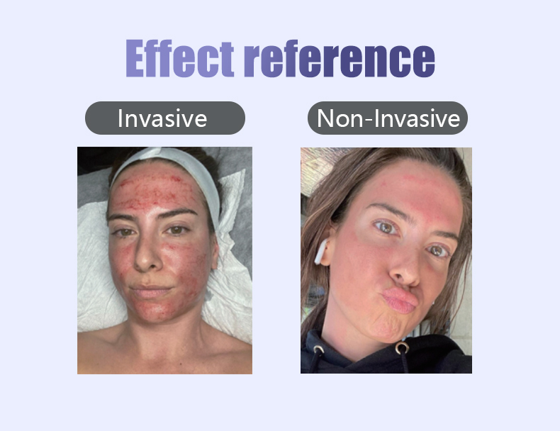 RF Microneedling Machine