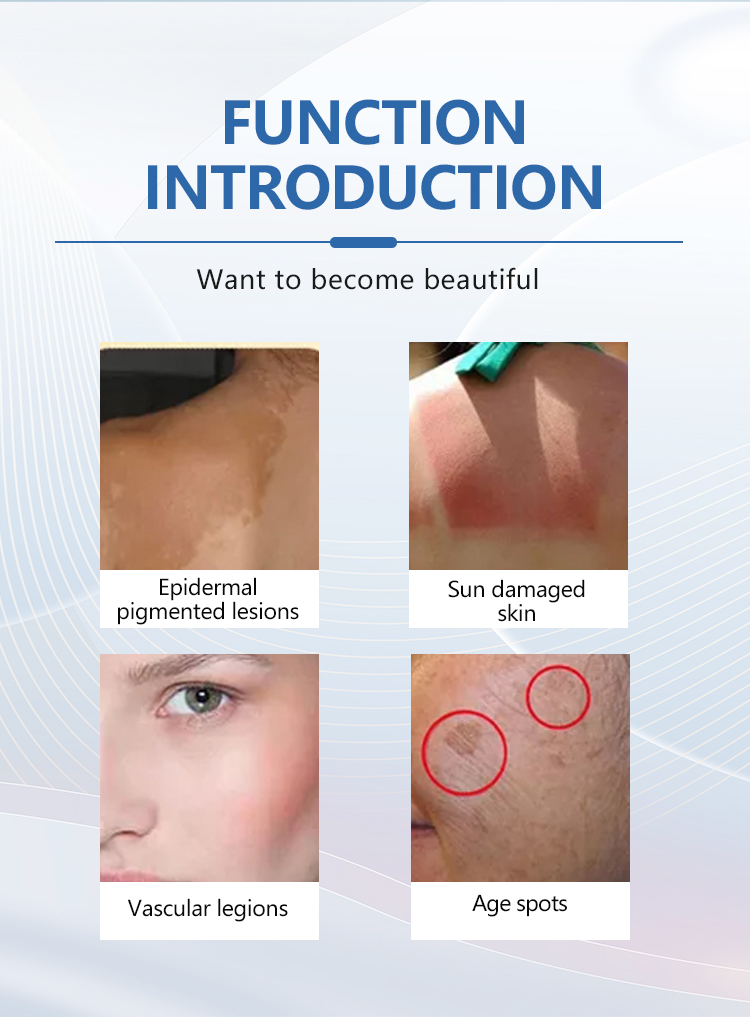 755nm laser alex hair removal