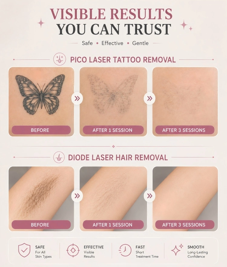pico 808 diode laser hair tattoo removal machine