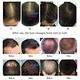 laser hair growth