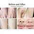 Best Selling Laser Hair Removal Machine