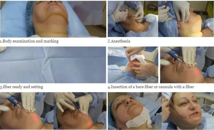 Liposuction Laser