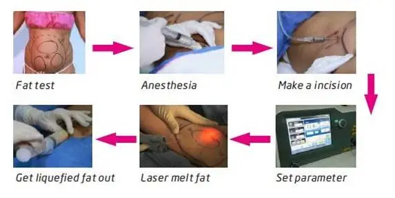 Liposuction Laser