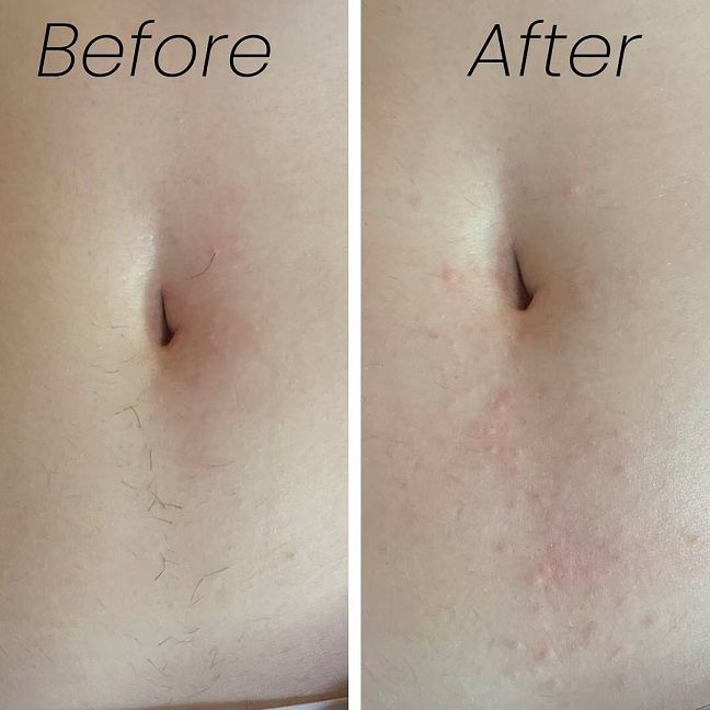 hair removal