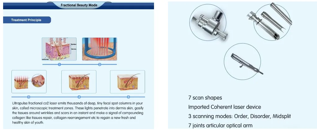 CO2 Laser Vaginal Tightening