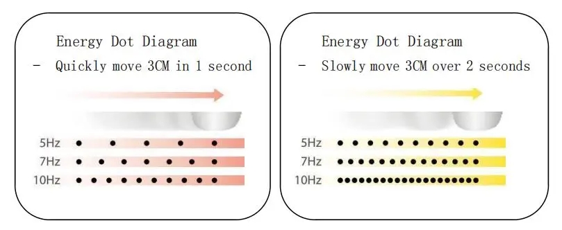 hifu double chin  manufacturer