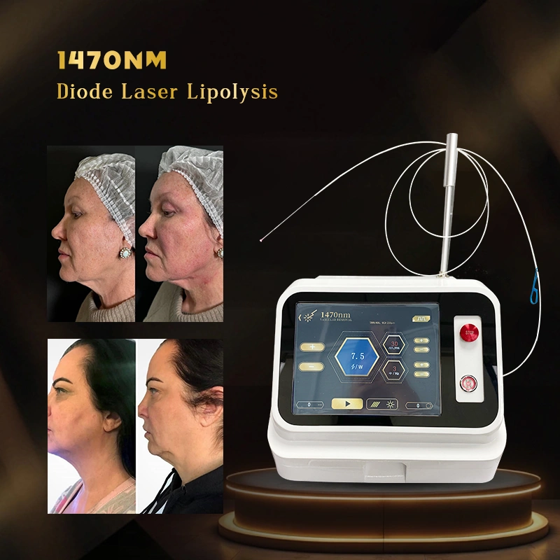 1470nm diode laser lipolysis