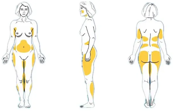980nm diode laser liposuction