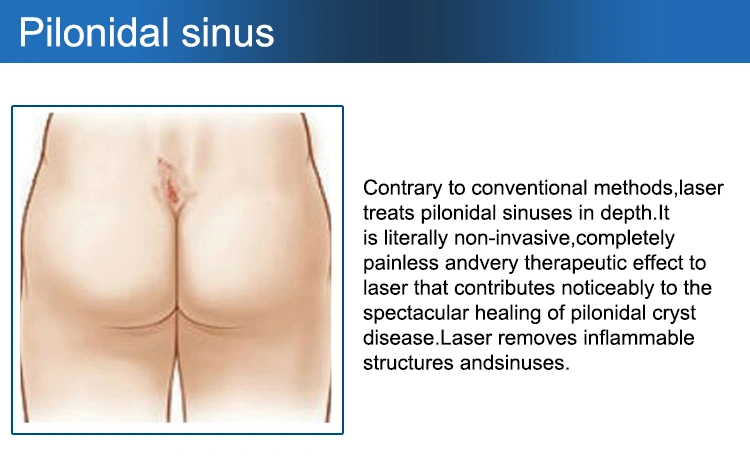 hemorrhoids laser hemorrhoid 1470