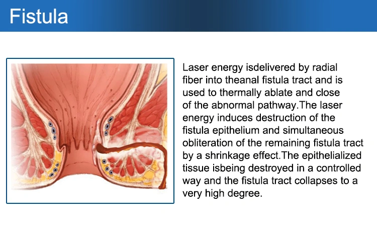 1470 laser Ablation Hemorrhoidectomy Machine