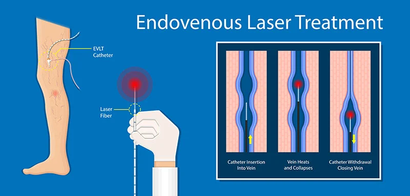 EVLT Endovenous Veins Laser Treatment