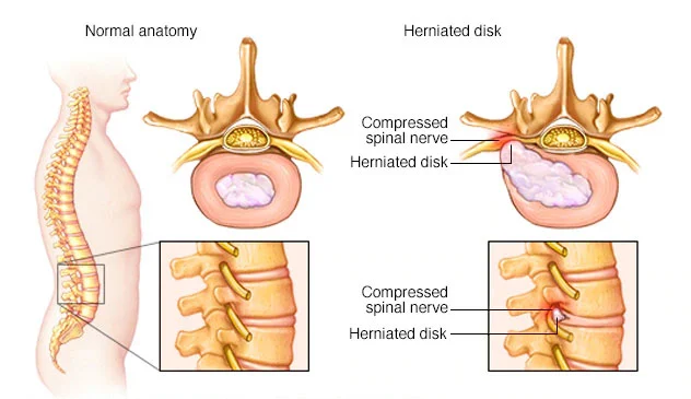 Percutaneous Laser Disc Decompression