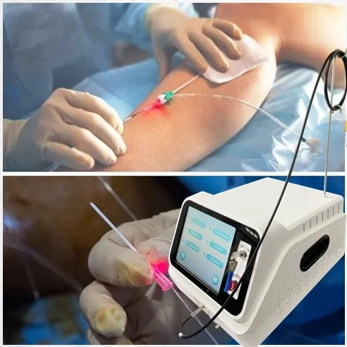 Endovenous Laser Ablation