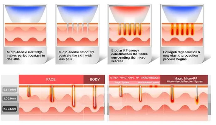 rf skin tightening machine