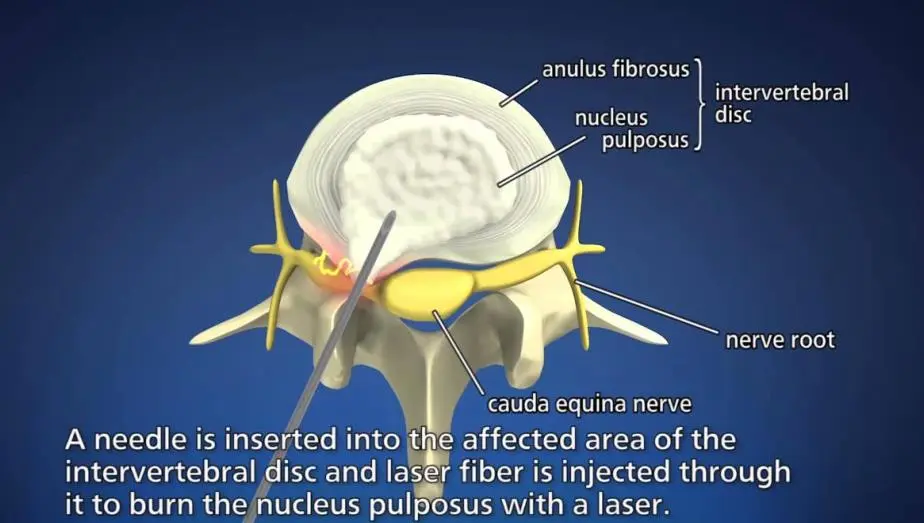 Percutaneous Laser Disc Decompression