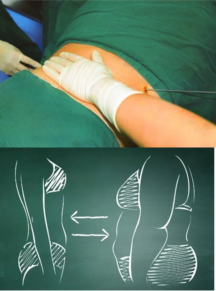 Plastic surgery endolift