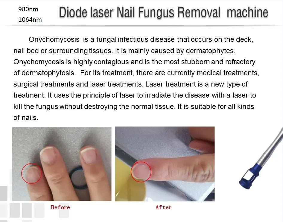 Diode Laser