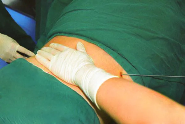 1064nm Diode Laser