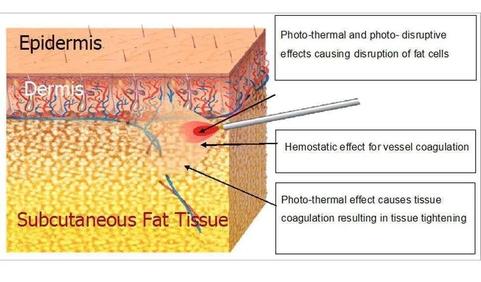 980nm Liposuction Laser