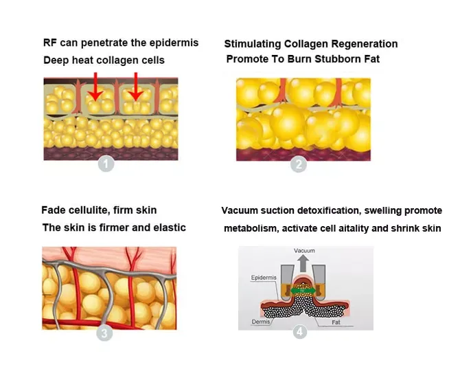vacuum non-invasive Slimming