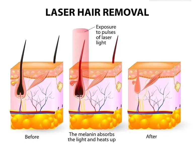 nd yag laser laser hair removal machine