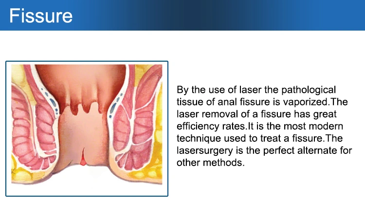 Hemorrhoid Remover 980nm 1470nm Diode Laser