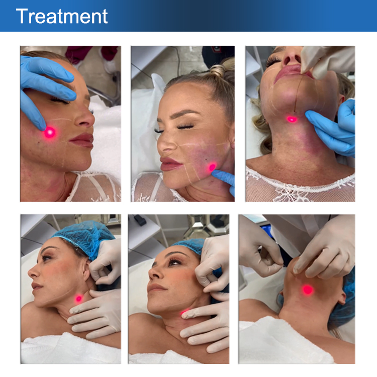 endolift laser papada