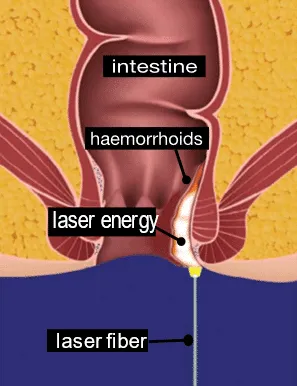 haemorrhoids laser