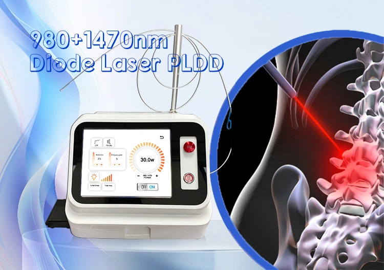 Percutaneous Laser Disc Decompression