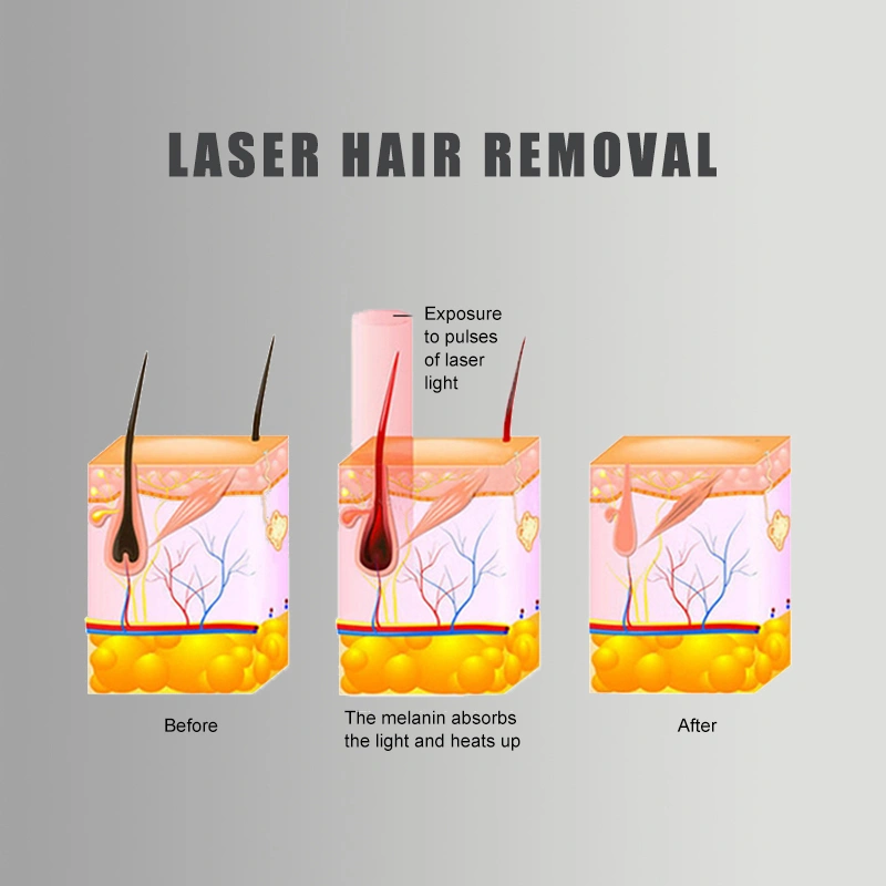 808nm diode laser Â