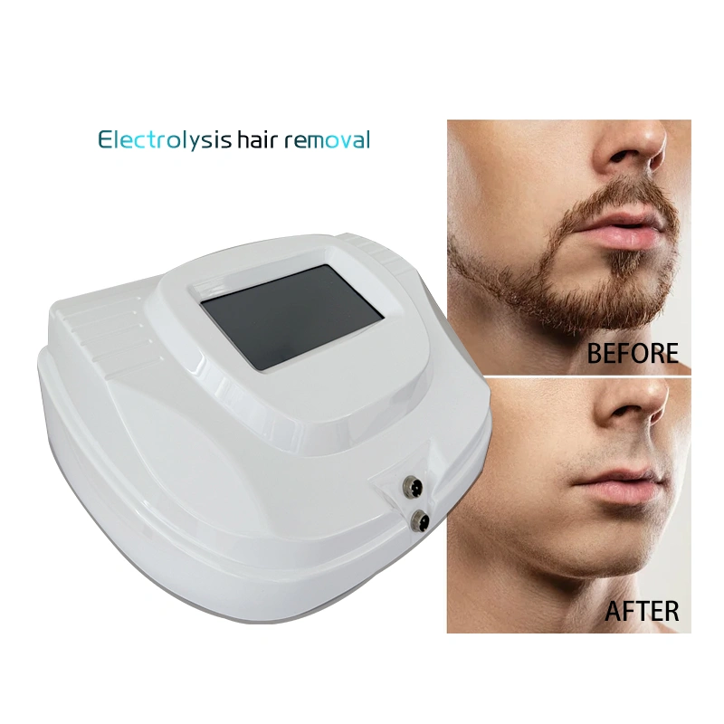 electrolysis hair removal