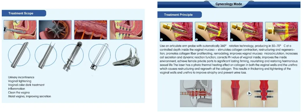 Laser Vaginal Treatment