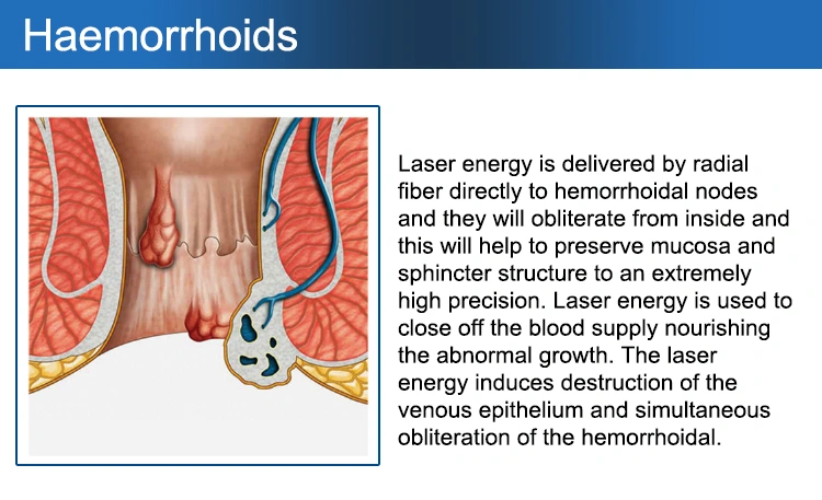 Pilonidal Sinus Hemorrhoid Anal Piles