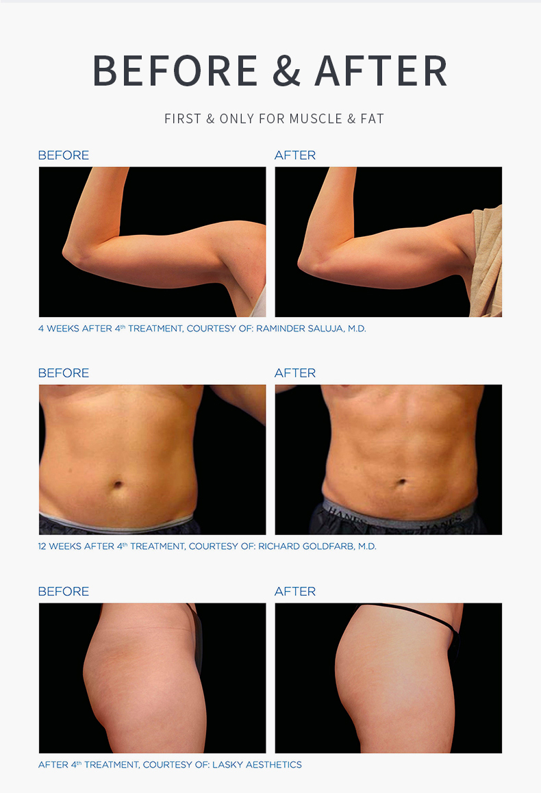 cellulite reduction machine