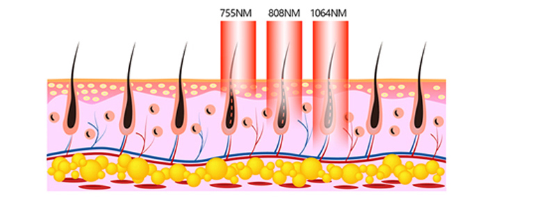 Laser Depilation