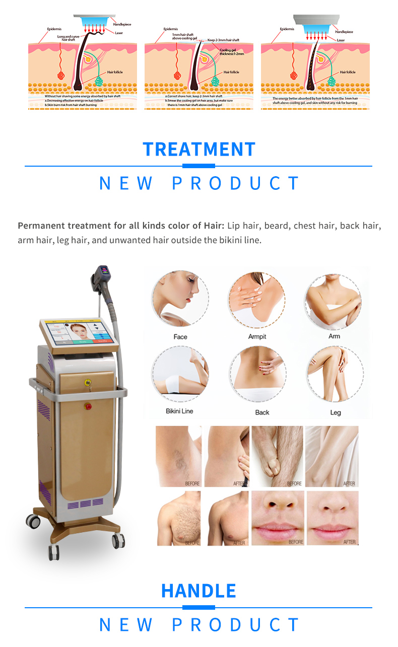 laser hair removal