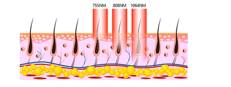 Laser Depilation