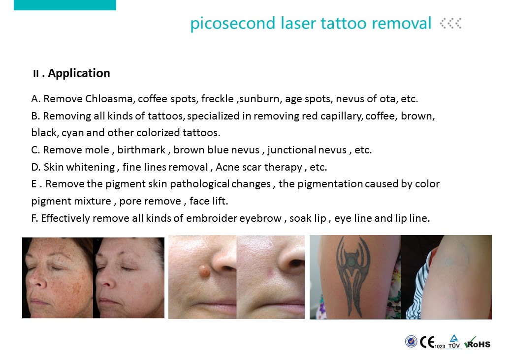 Tattoo Removal Machine